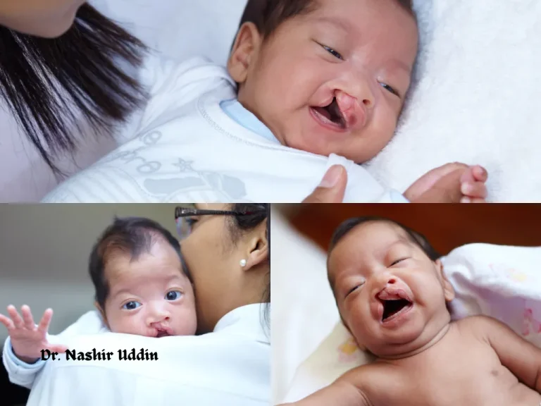 Cleft palate repair