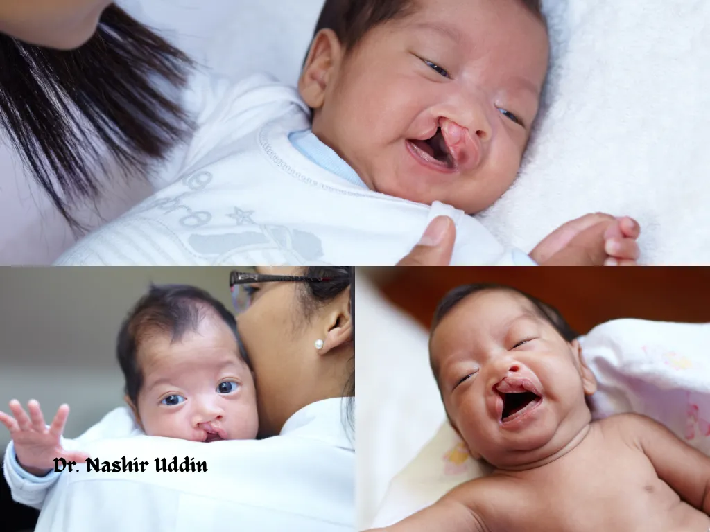 Cleft palate repair