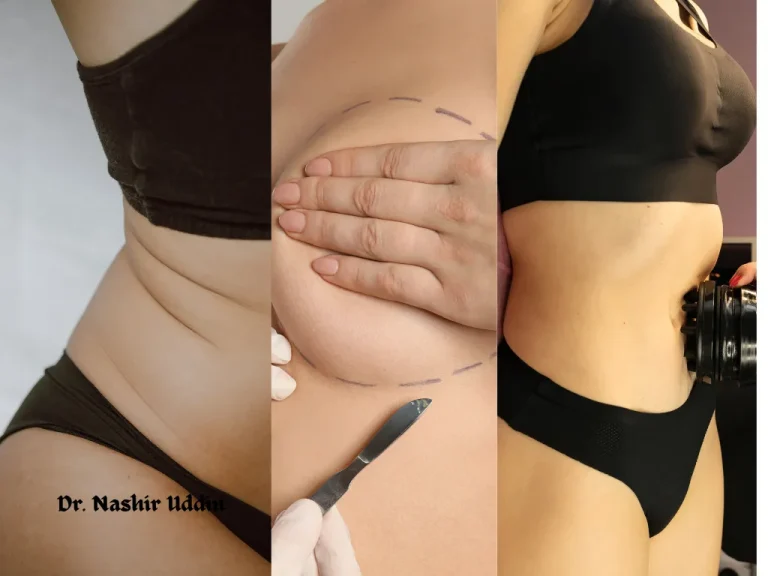 Combination Procedures Breast Tummy Body Contouring