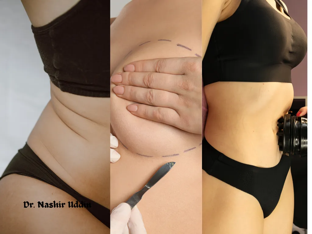 Combination Procedures Breast Tummy Body Contouring