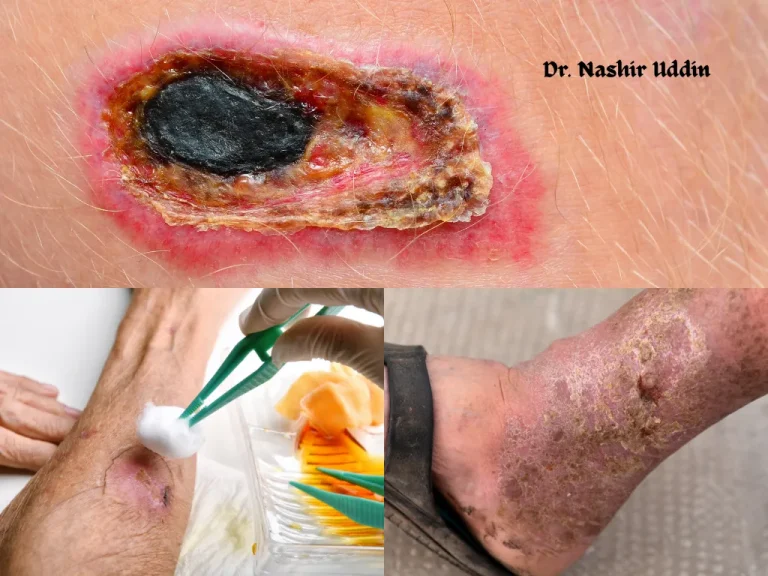 Managing Infected Wounds and Gangrene
