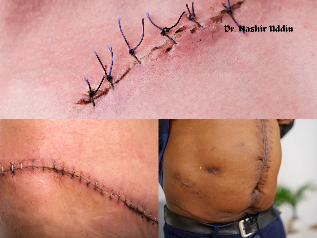 Post surgery scar management