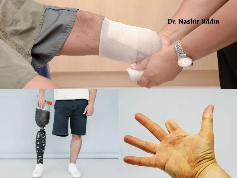 Preventing Amputation