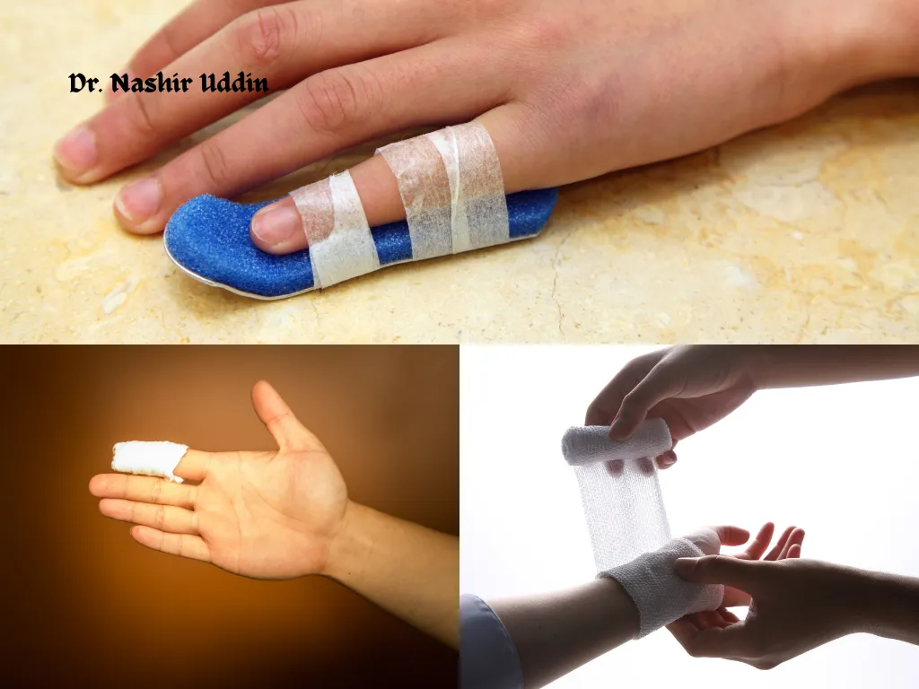 Reattaching Injured or Cut Fingers and Hands