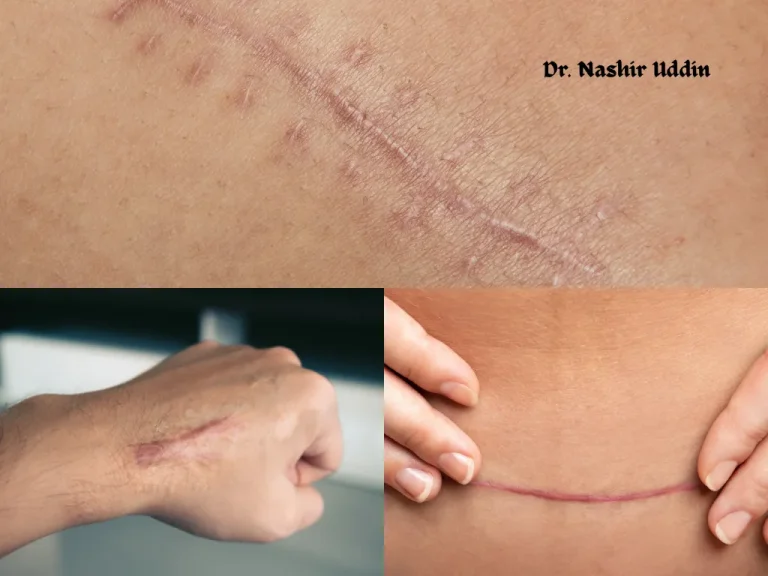 Reducing old scars