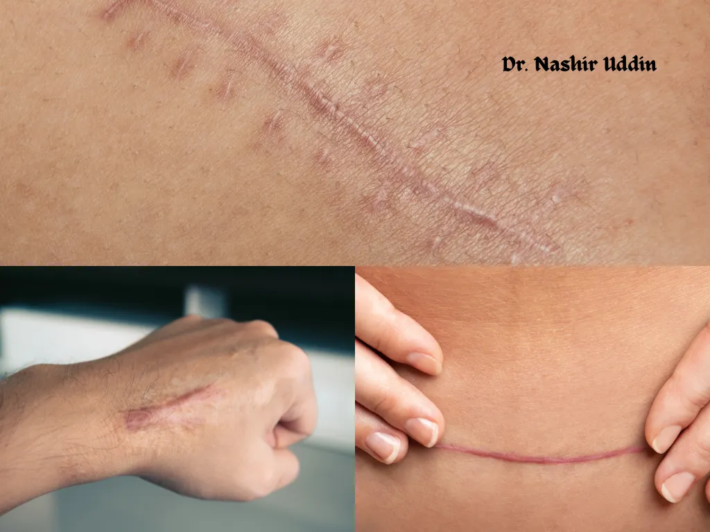 Reducing old scars