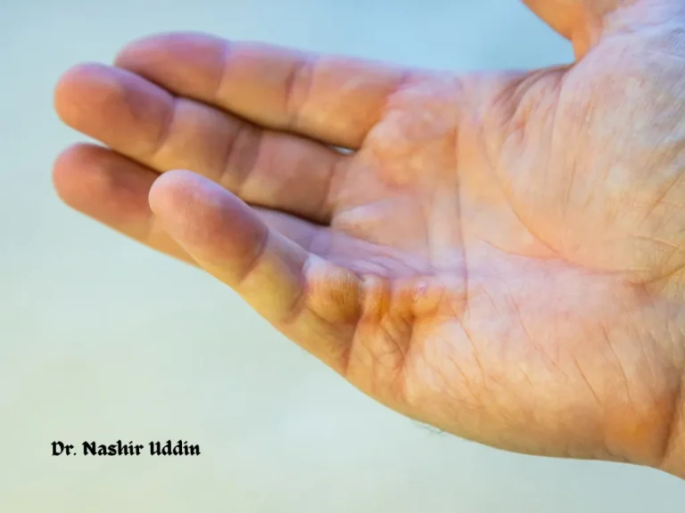 Release of contractures (tight or stiff skin after burns)