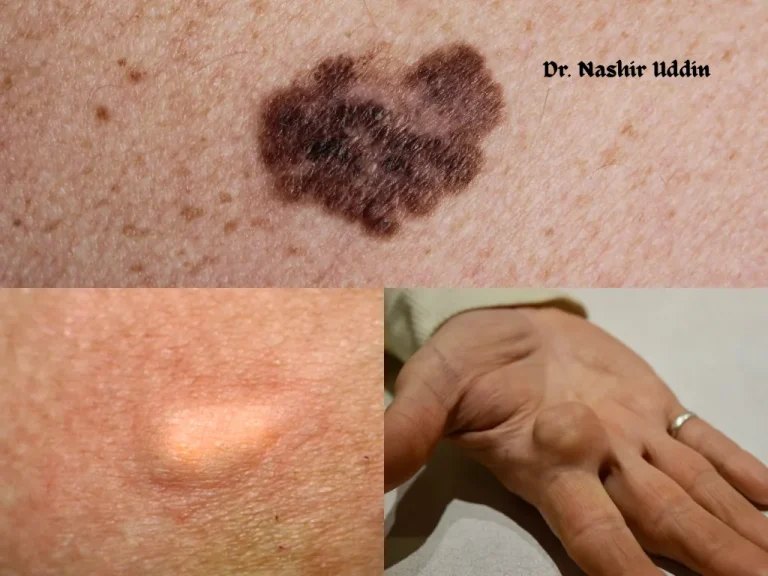 Removal of skin tumors