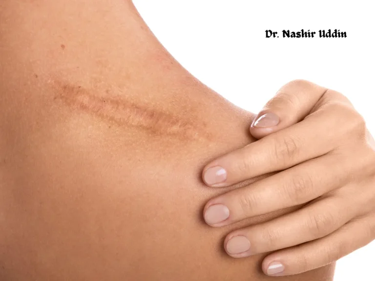 Scar revision (reducing visible scars)
