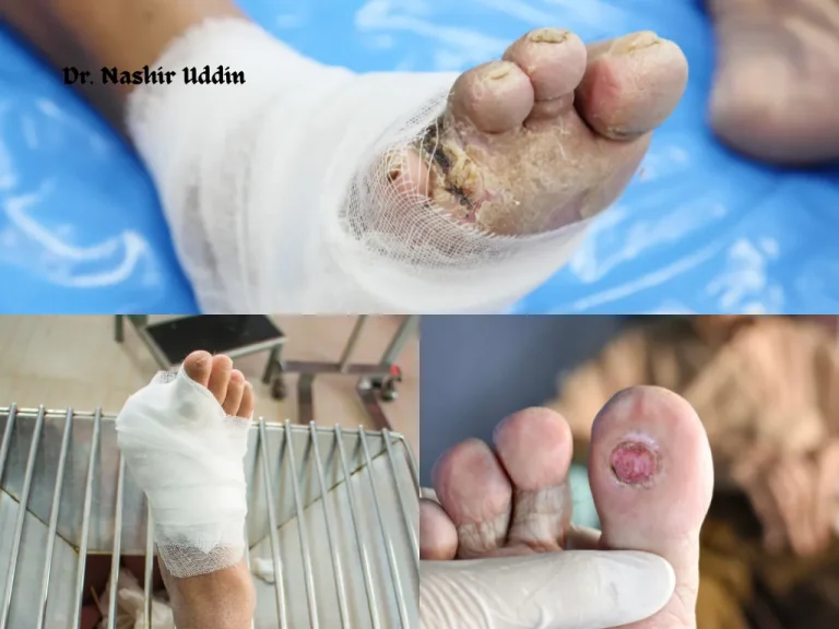 Treatment for Diabetic Foot Ulcers