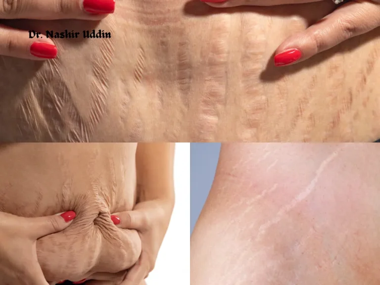 Treatment for Loose Skin and Stretch Marks