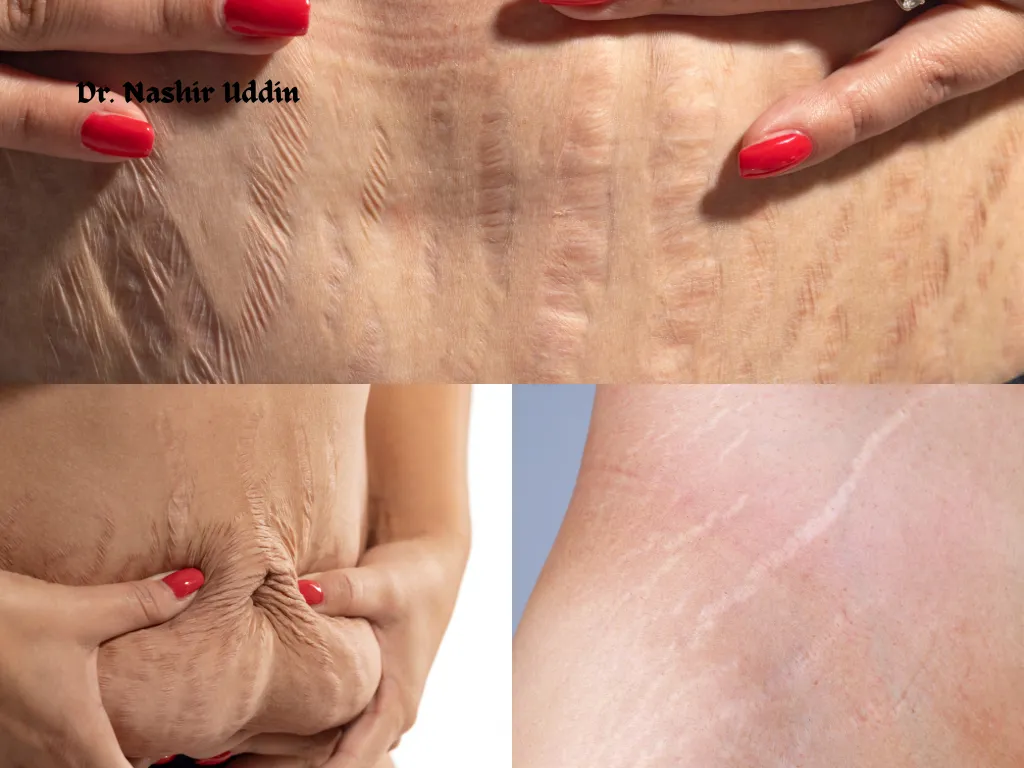 Treatment for Loose Skin and Stretch Marks