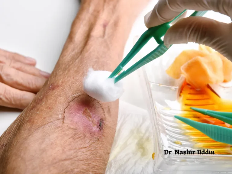 Treatment for non-healing or complex wounds