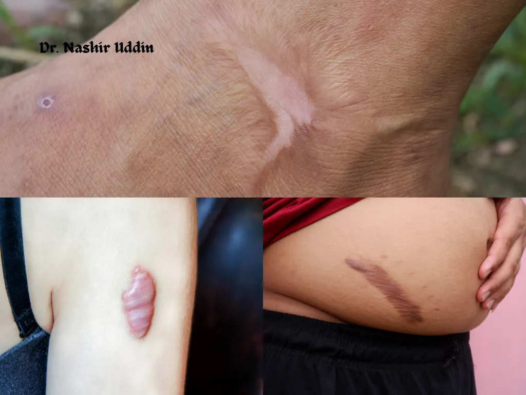 Treatment of keloids and thick scars
