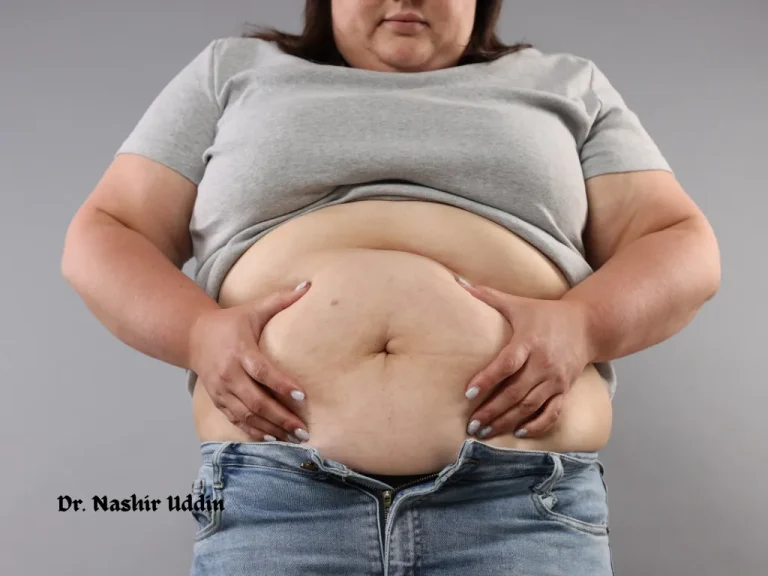 Tummy tuck removing loose skin and fat from the abdomen
